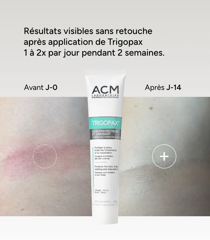 ACM TRIGOPAX